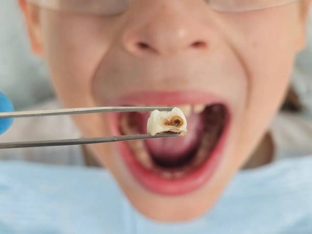Best Emergency Wisdom Teeth Removal in Hart, MI